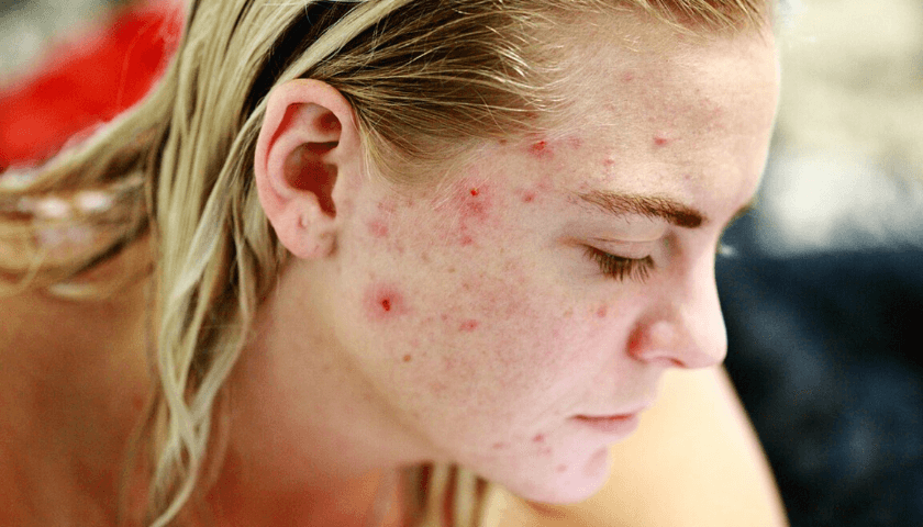 rosto de mulher cheio de acne