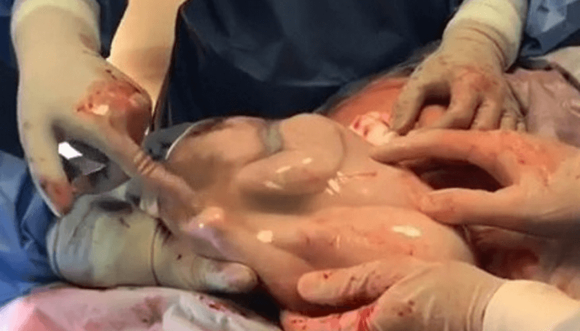 medico faz parto de gemeos empelicados - fotografias de parto