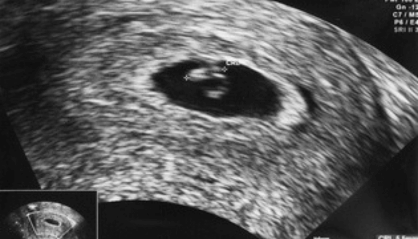 ultrassom- bebê