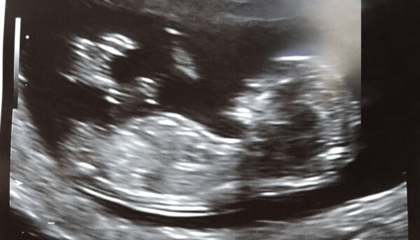 ultrassom com 14° semanas de gravidez