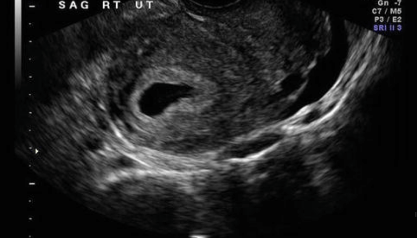 gravidez ectópica ultrassom